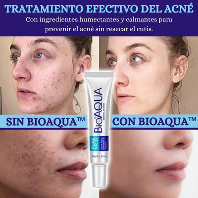 💧 COMBO KIT ANTI ACNE BIOAQUA - Lleva 4 productos 🌟